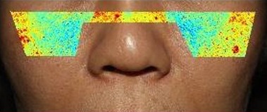4주 사용 후 — 코 아래 얼굴 사진, 좌우 볼에 속 멜라닌 색 지도