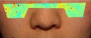 사용 전 — 코 아래 얼굴 사진, 좌우 볼에 겉 멜라닌 색 지도(빨강 · 노랑 · 초록)