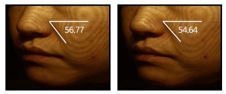 뺨 피부를 등고선으로 촬영한 사진 두 장. 제품 사용 전 각도 표시 56.77, 제품 4주 사용 후 각도 표시 54.64
