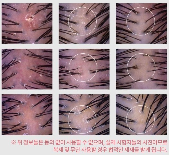 두피(붉은기) 진정 효과 시험 9컷 — 피험자들의 [사용 전], [사용 2주 후], [사용 4주 후] 두피 붉은기 변화 측정 사진